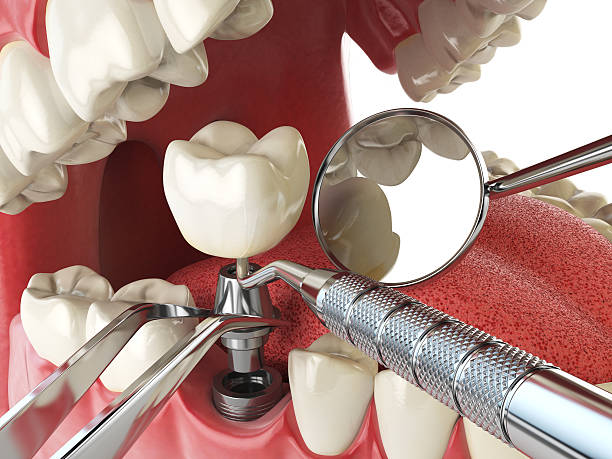 Best Emergency Wisdom Tooth Extraction in Woodsi East, DE